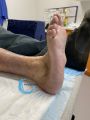 Pied de Charcot20.jpg