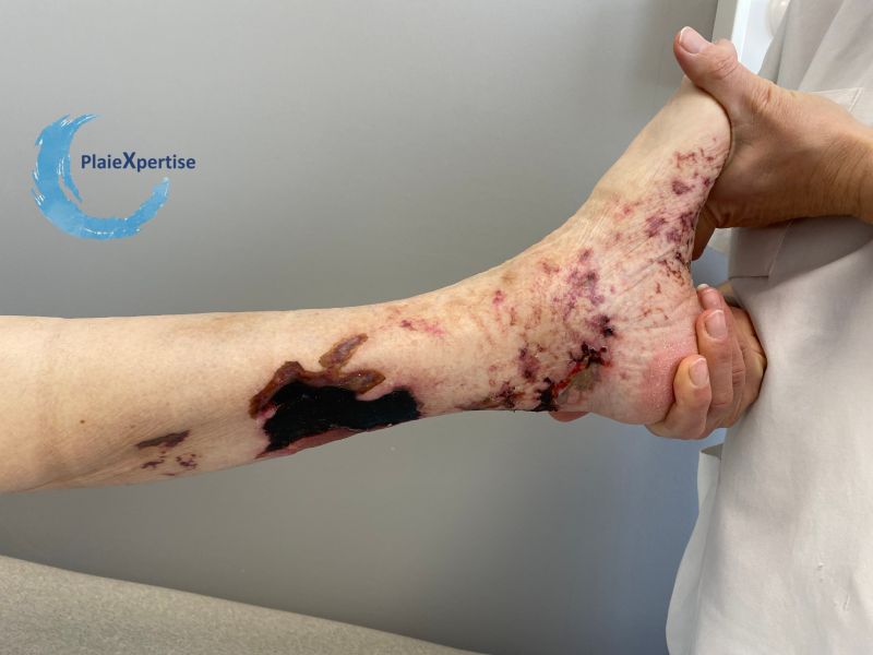 Fichier:Vascularite30.jpg