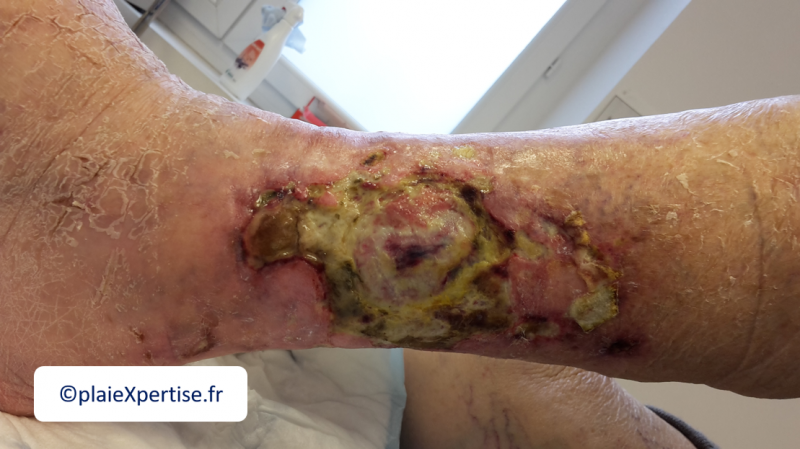 Fichier:Angiodermite atypique8.png