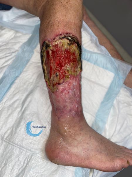 Fichier:Angiodermite typique138.jpg