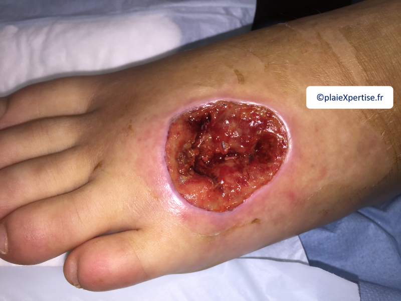 Fichier:Cou de pied20.png