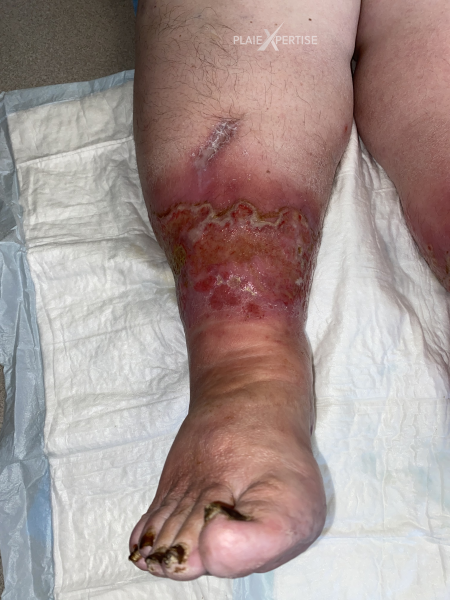 Fichier:Hypodermite chronique33.png