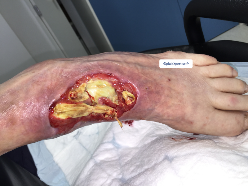 Fichier:Tendon nécrotique humide16.png