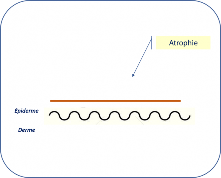 Fichier:Atrophie(LE).png