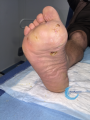 Pied de Charcot11.png
