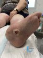 Pied de Charcot37.jpg