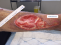 Pyoderma gangrenosum3.png