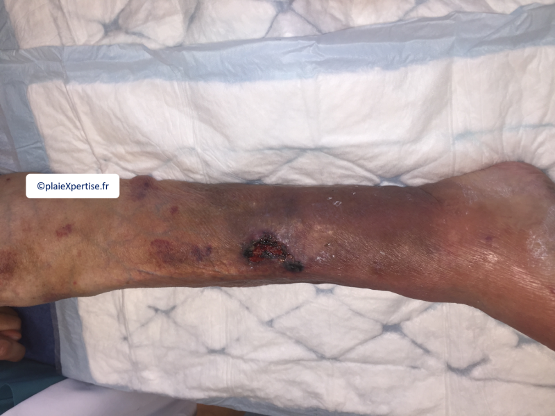 Fichier:Dermatoporose6.png