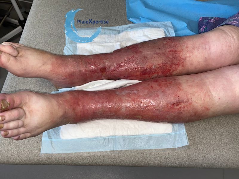 Fichier:Eczéma107.jpg