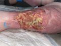 Calcifications45.jpg