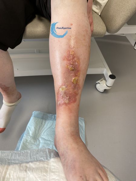 Fichier:Eczéma163.jpg