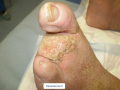 Lymphoedème pied8.png