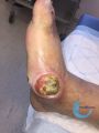 Pied de Charcot16.jpg