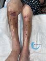 Dermatoporose34.jpg