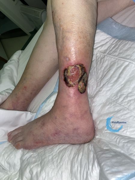 Fichier:Angiodermite typique116.jpg