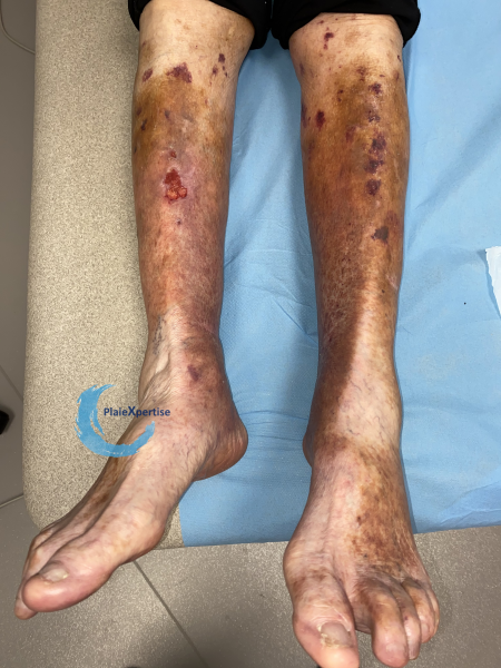 Fichier:Dermatoporose28.png