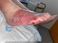 Dermite d'irritation209.jpg