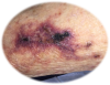 Calci.png