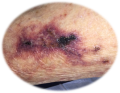 Calci.png