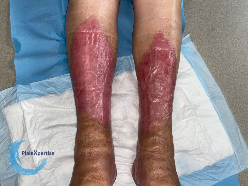 Fichier:Nécrobiose lipoïdique26.jpg