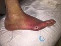 Pied infecté36.jpg
