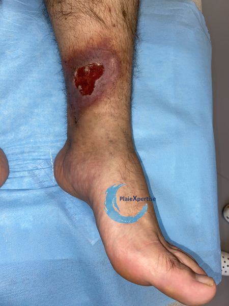 Fichier:Ulcère veineux21.jpg