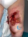 Clciphylaxie 27.jpg