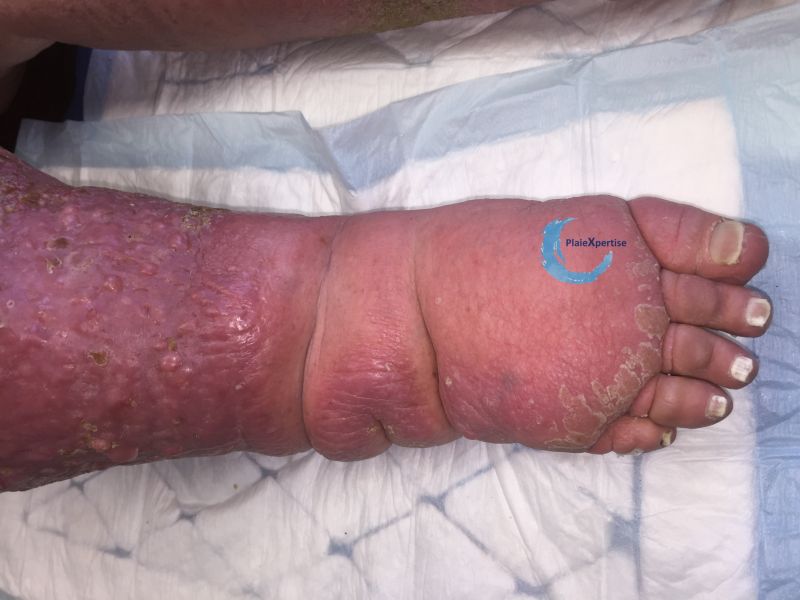 Fichier:Grosses jambes suintantes32.jpg
