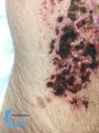 Pyoderma gangrenosum52.jpg