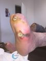 Pied infecté44.jpg