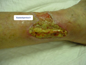 Tendon nécrotique humide9.png