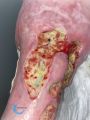 Calcifications44.jpg