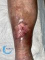 Epidermisation12.jpg