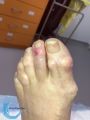 Goutte et tophus35.jpg