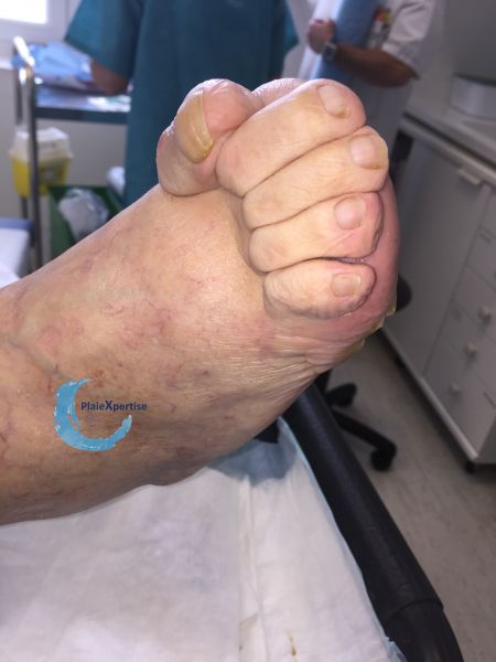 Fichier:Pied déformé5.jpg
