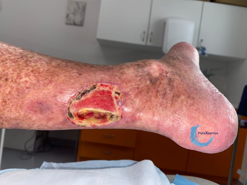 Fichier:Angiodermite typique131.jpg