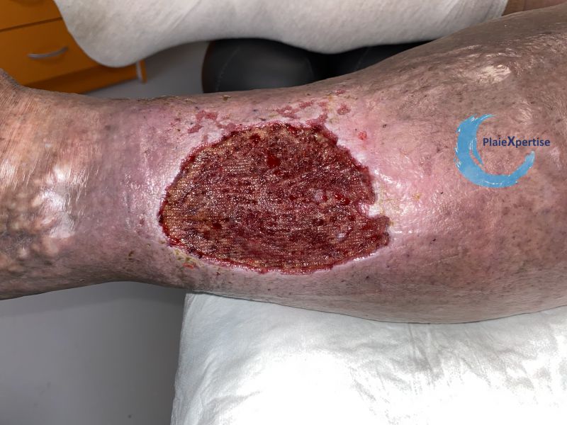 Fichier:Tissu de granulation inflammatoire37.jpg