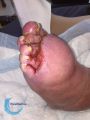 Lymphoedème73.jpg