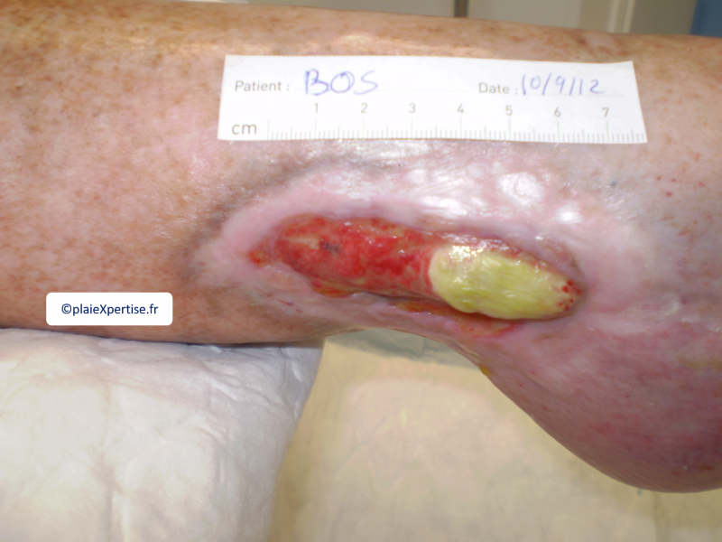 Fichier:Tendon normal10.png