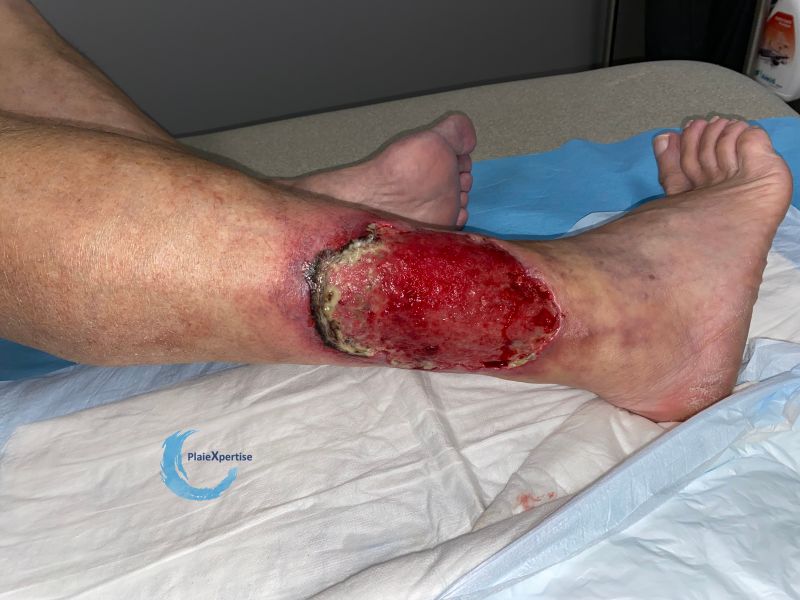 Fichier:Angiodermite typique108.jpg