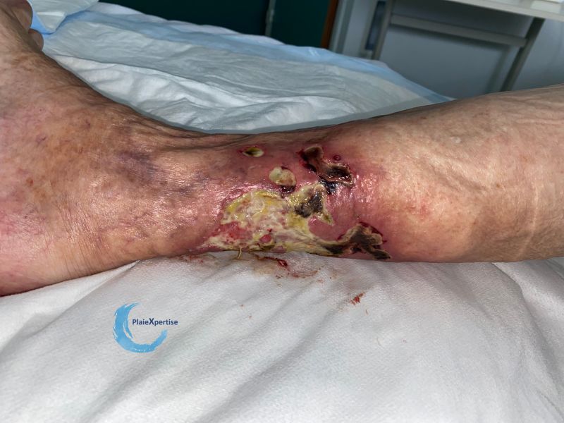 Fichier:Angiodermite typique114.jpg