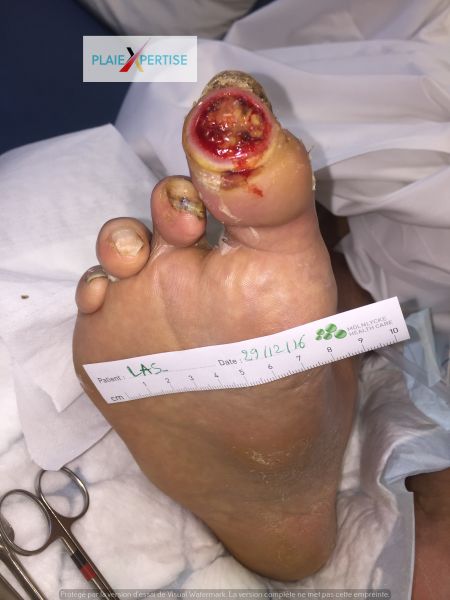 Fichier:Nécrose humide Pied 1.jpg