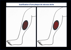 Scarification.png