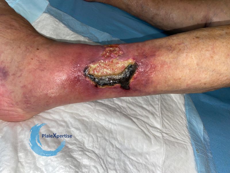 Fichier:Angiodermite typique78.jpg
