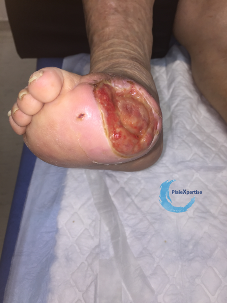 Fichier:Pied de Charcot12.png