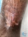 Epidermisation15.jpg