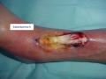 Tendon nécrotique humide12.png