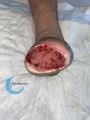 Amputation49.jpg