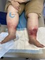 Dermite d'irritation159.jpg