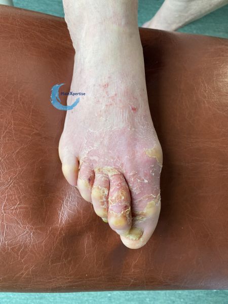 Fichier:Eczéma154.jpg